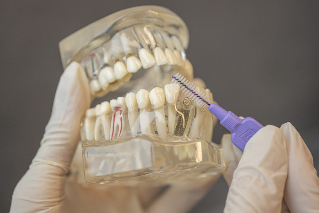 Patienten sollten die Pflege des Zahnimplantats direkt nach der OP, aber auch langfristig gesehen sehr gründlich durchführen